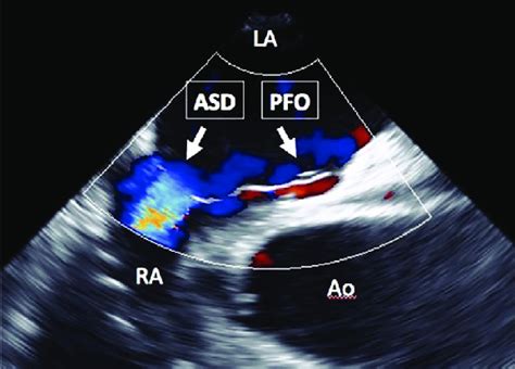Two Dimensional Transesophageal Echocardiographic View 90 Degrees On