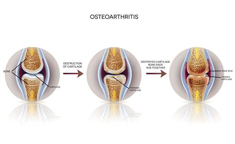 Osteoarthritis Of The Knee Stages Diagnosis And Treatment