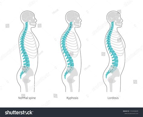 Vektor Stok Spinal Deformity Flat Vector Illustration Kyphosis Tanpa