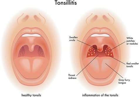 What Is The Treatment For Tonsillitis