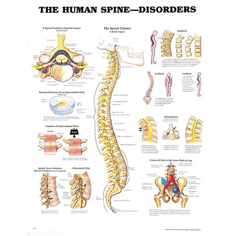 Human Spine Disorders Chart 20 W X 26 H