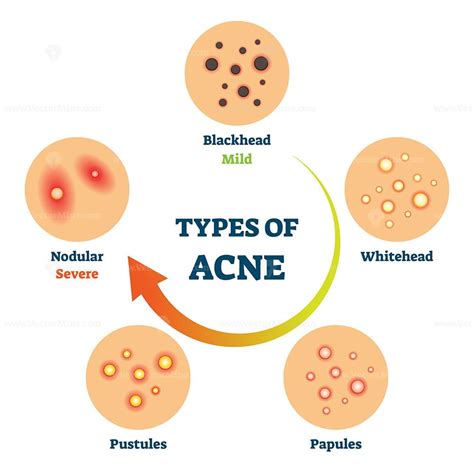 Types Of Acne As Medical Skin Disease Comparison Scheme Vector