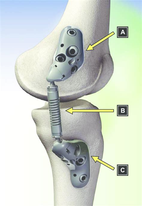 Components Of The Kinespring ® Knee Implant System Moximed Inc