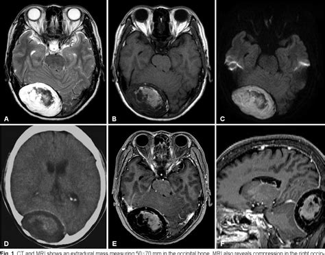 Figure 1 From Giant Intradiploic Epidermoid Cyst In The Occipital Bone