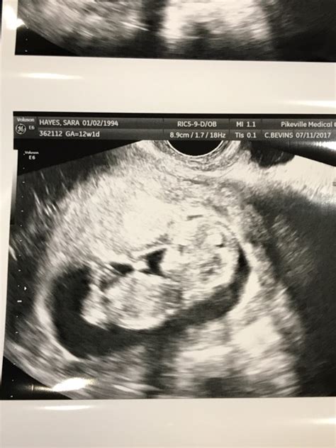 12 Weeks Ultrasound Any Guesses On Gender Glow Community