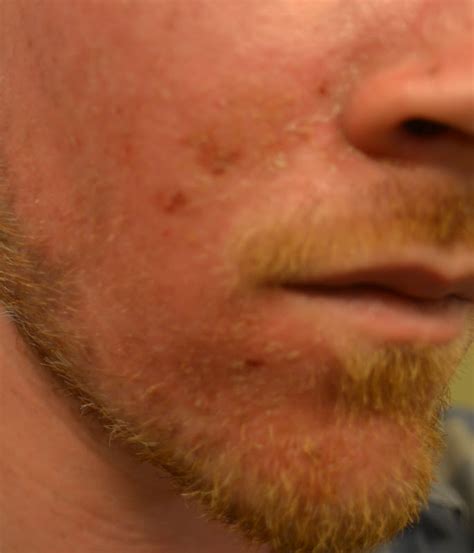 Skin Cancer Spots On Face