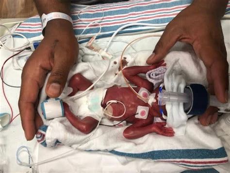 Micro Preemie Baby Returns Home After 5 Months In Nicu At Texas Hospital