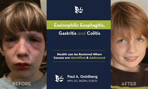 “eosinophilic Esophagitis Gastritis And Colitis” The Goldberg Tener