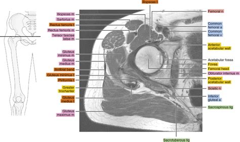 Mri Of The Hip Radiology Key