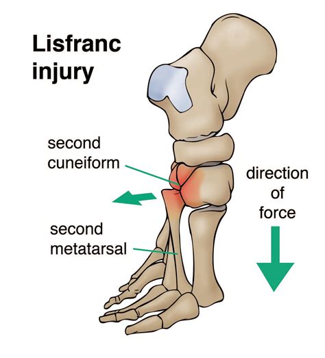 Lisfranc Injuries An Uncommon Midfoot Injury