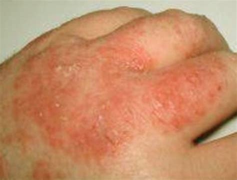 Fungal Rash Pictures