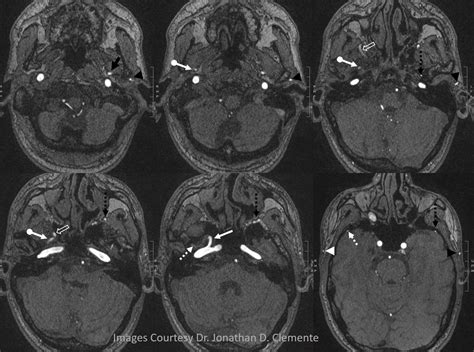 Middle Meningeal Artery