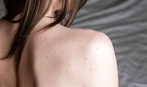 Tips For Preventing And Getting Rid Of Shoulder Acne Proactiv®