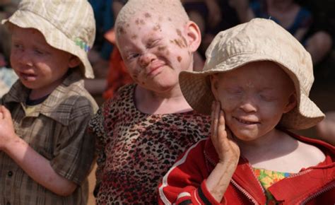 Tanzania Attacked For Body Parts Tanzanian Albino Children Get New