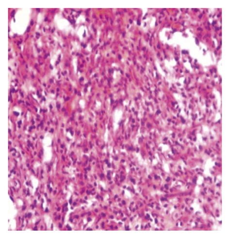 Third Histology Report Of Hodgkins Lymphoma Haematoxylin And Eosin