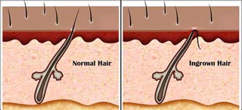 Ingrown Armpit Hair Lymph Node Pictures Lump How To Get Rid Home Remedies Symptoms