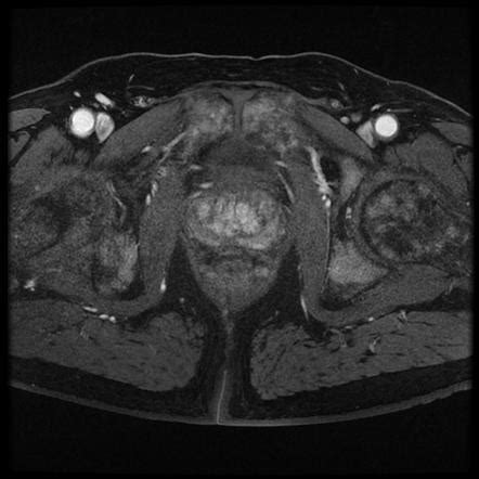 Prostate Cancer Summary Radiology Reference Article Radiopaedia Org