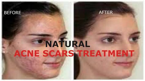 How To Clear Acne Scars Get Rid Of Scars On Face Home Remides Natural