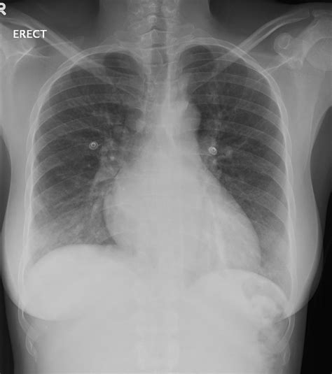 Acute Chest Syndrome Xray Captions Profile