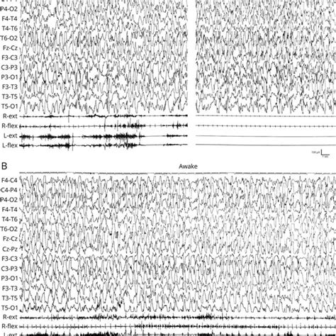 Patient 1 Myoclonic Status Download Scientific Diagram