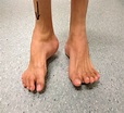 Foot Deformity Singapore | Surgery Reconstruction | Treatment