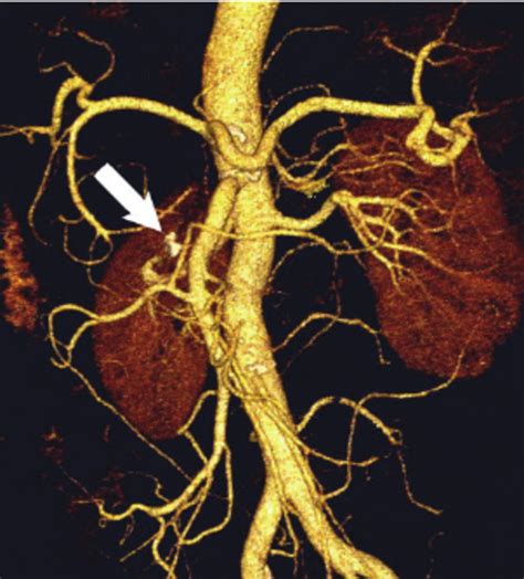 Ct Angiogram Shows Occlusion Of The Aneurysm With Coil In Situ Arrow