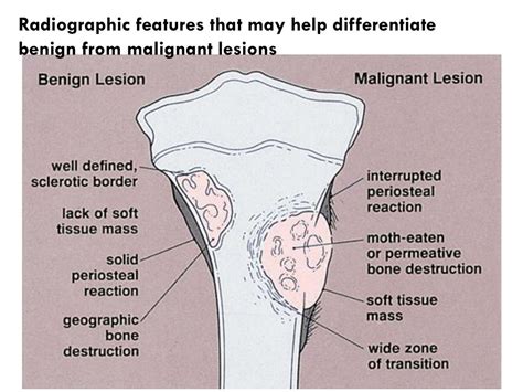 Ppt Primary Bone Tumors Presenter Ondari Nj Facilitator Prof