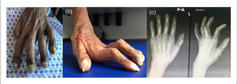 Figure 1 From A Rare Case Of Acrodermatitis Continua Of Hallopeau