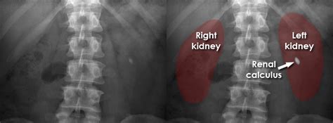 Abdominal X Ray Gallery Calcification Renal Calcification