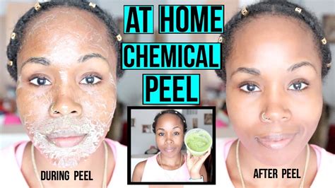 How To Make A Natural Chemical Peel At Home Erase Acne Wrinkles