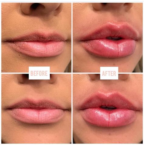 Lips By Linasev 1 Full Syringe Of Juvederm Ultra Xc Currently Taking Appointments Space Is