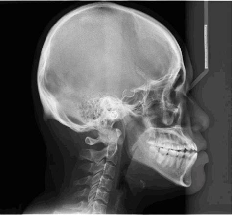 The bones of the head are divided into those of the skull, ear, and face. Occipital spur: understanding a normal yet symptomatic ...