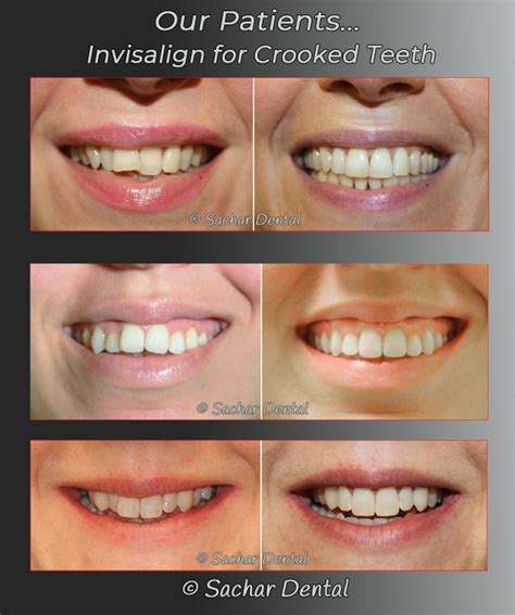 Dentist Nyc Invisalign For Crowded Teeth Sachar Dental Nyc