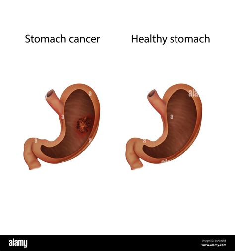 Stomach Cancer And Healthy Stomach Illustration Stock Photo Alamy