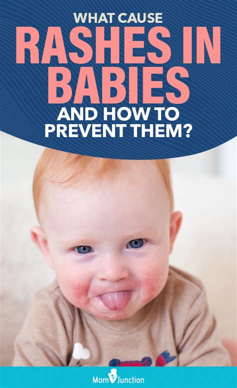 What Cause Rashes In Babies And How To Prevent Them Baby Cheeks