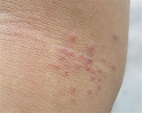 What Living In Singapore Does To Your Skin Skin Leg Rash Itchy Skin