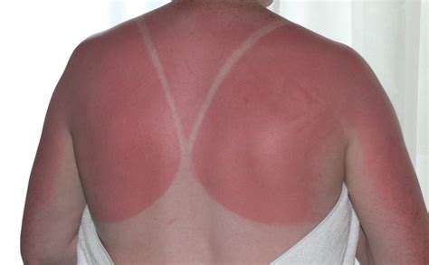 Sunburn Aftercare Tips Treatments Greg Keily Chemist Southport