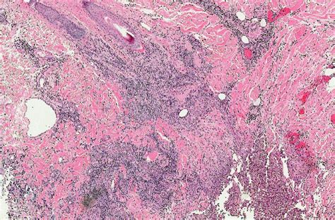 Ecthyma Gangrenosum Histology