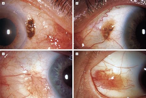Conjunctival Nevi Clinical Features And Natural Course In 410