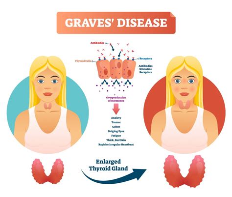 What Is Graves Disease Causes Symptoms Diagnosis Treatment