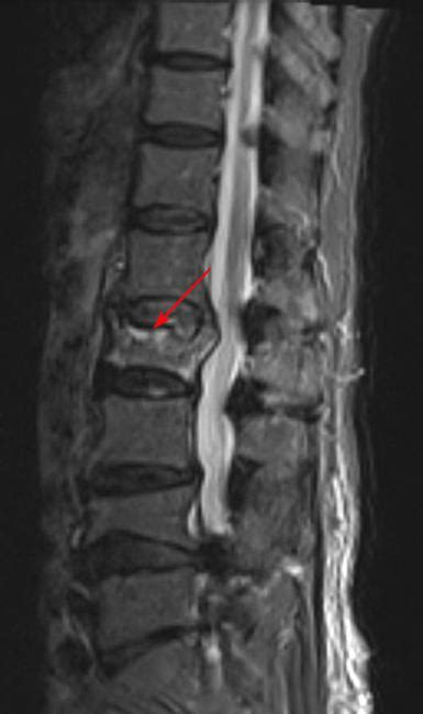 A distributed backbone is a backbone network that consists of a number of connectivity devices connected to a series of. Osteoporosis and Spinal Fractures - OrthoInfo - AAOS