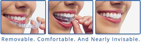 Straighten Your Teeth With Invisalign Greater Vancouver