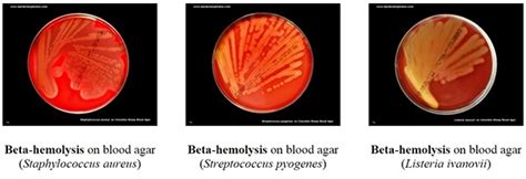 Patients with cancer, particularly those of blood, are also at high risk for listeria infection. Blood Agar- Composition, Preparation, Uses and Pictures