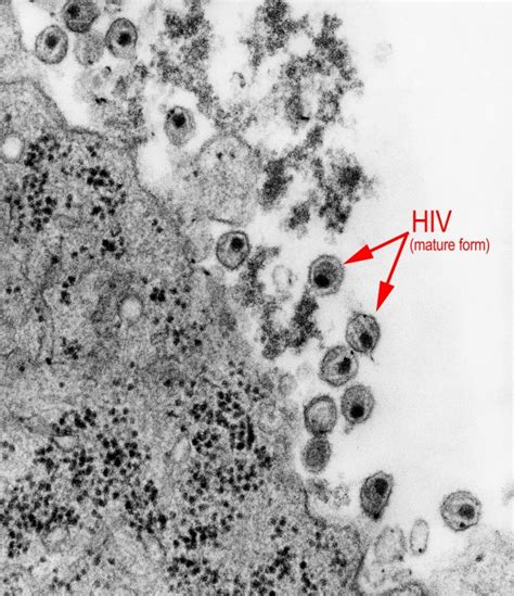 Electron Micrograph Of Hiv Mature Form Biology Of Humanworld Of Viruses