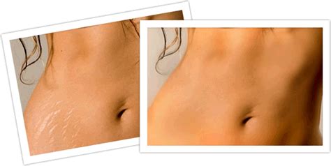 Laser Surgery For Stretch Marks | Stretch marks, Health, beauty, Skin care