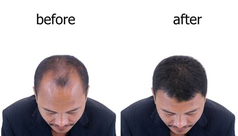 Hair Loss Iron Deficiency Regrowth Hair Loss
