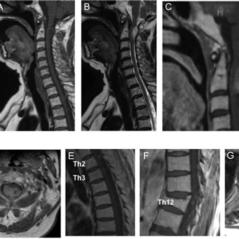 A Preoperative T1 Weighted Sagittal Magnetic Resonance Imaging Mri