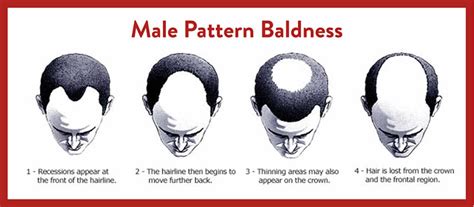 Male Pattern Baldness Treatment Slc Utah Facial Plastics
