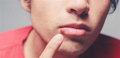 Cold sores can vary in appearance depending on how severe the infection is, from small spots to full blown blisters. What is a Cold Sore? Understanding This Common Ailment