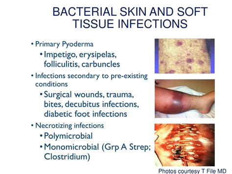 Ppt Update Skin And Soft Tissuesst Infections Features Of
